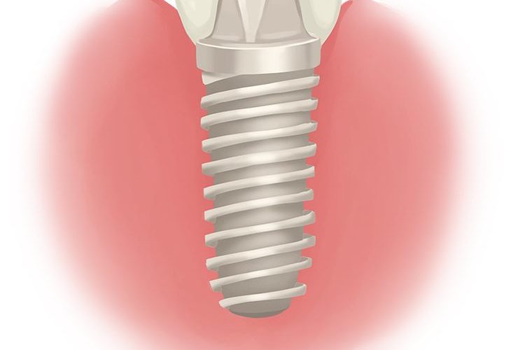 A fogimplantátumokról röviden, tömören